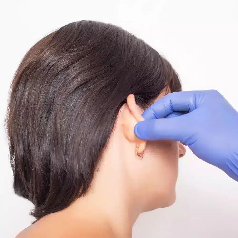 Otoplasty