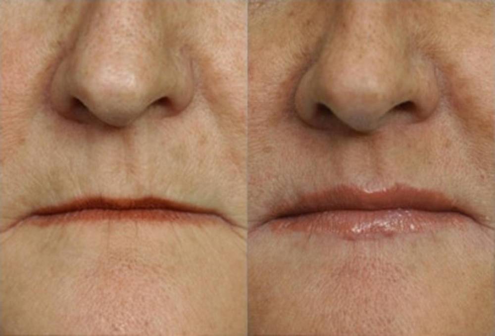 Central-lip-surgery