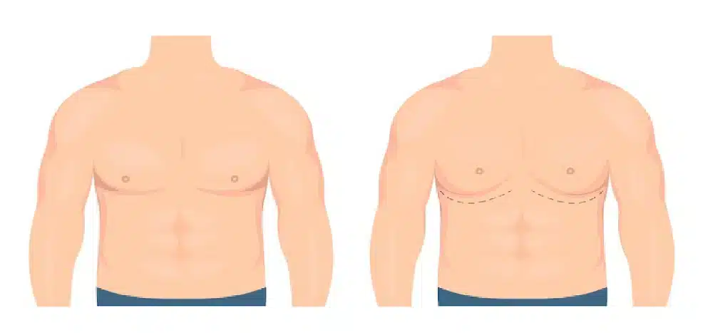Gynecomastia