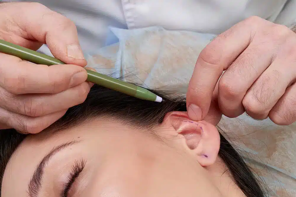 Otoplasty Surgery