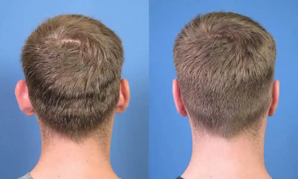 Otoplasty Surgery