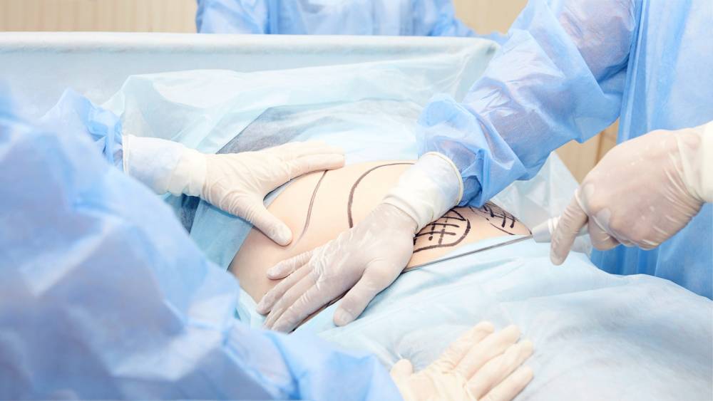 Postpartum body cosmetic surgery