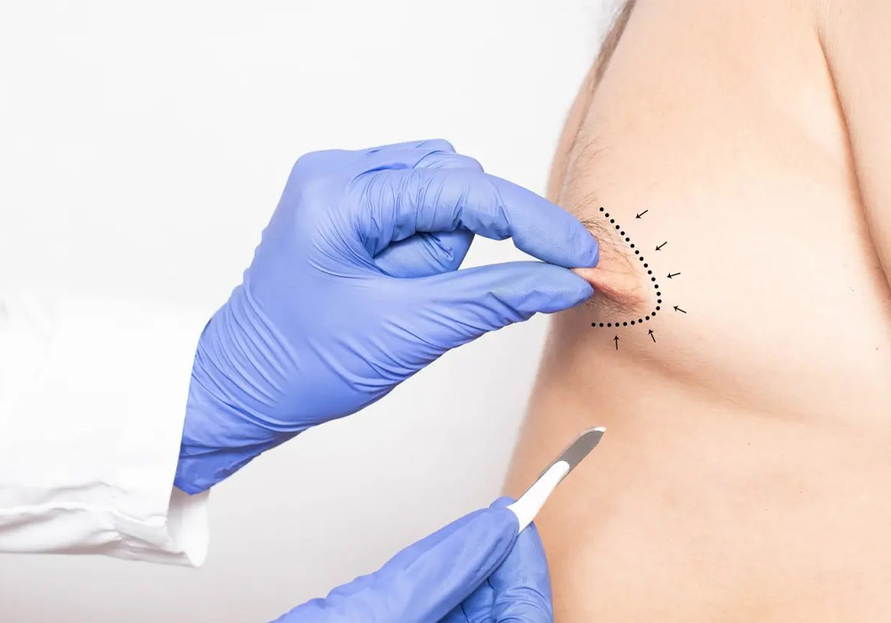 Signs and symptoms of gynecomastia at different ages