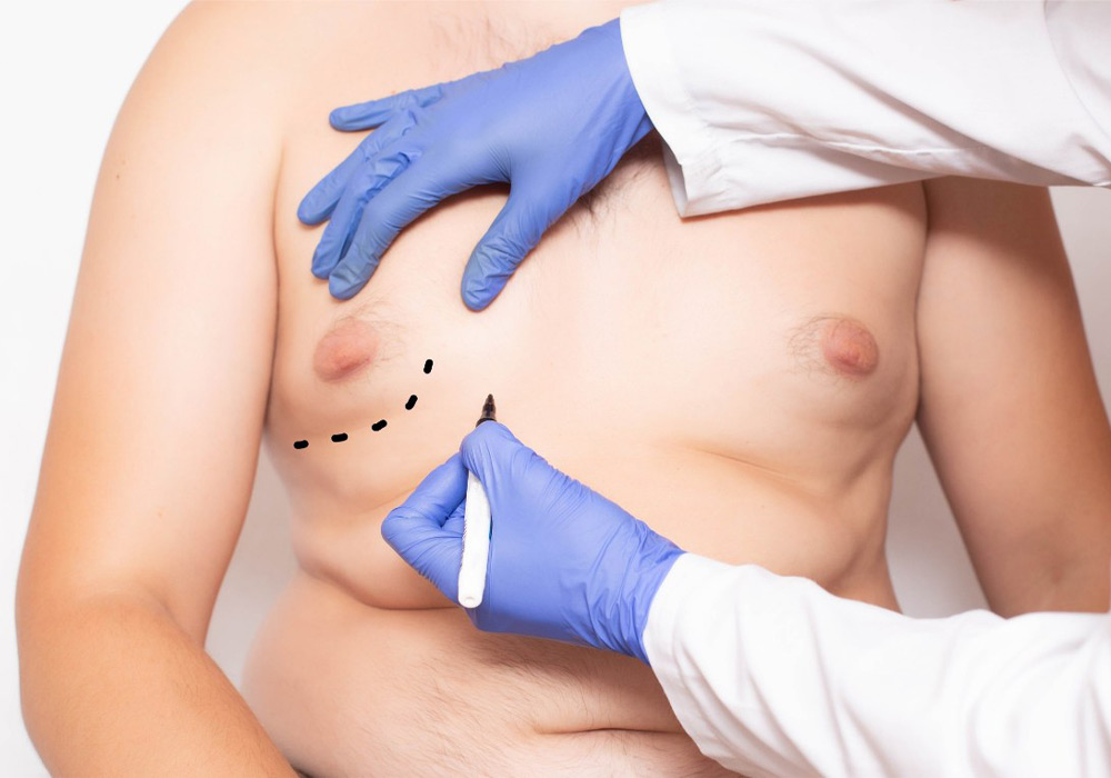 Signs and symptoms of gynecomastia at different ages