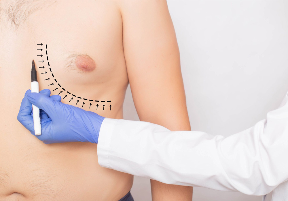 Signs and symptoms of gynecomastia at different ages