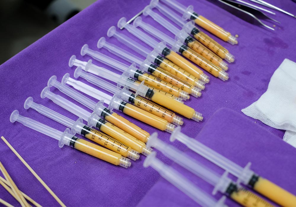 Best age for facial fat injection procedure